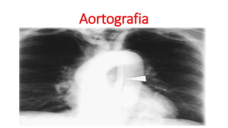 Aortografia
 
