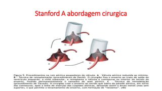 Stanford A abordagem cirurgica
 