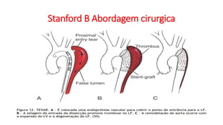 Stanford B Abordagem cirurgica
 
