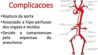 Complicacoes
•Roptura da aorta
•Associado a hipo-perfusao
dos orgaos e tecidos
•Devido a compreensao
pela expansao do
aneurisma
 