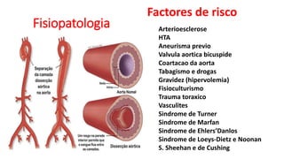 Fisiopatologia Arterioesclerose
HTA
Aneurisma previo
Valvula aortica bicuspide
Coartacao da aorta
Tabagismo e drogas
Gravidez (hipervolemia)
Fisioculturismo
Trauma toraxico
Vasculites
Sindrome de Turner
Sindrome de Marfan
Sindrome de Ehlers’Danlos
Sindrome de Loeys-Dietz e Noonan
S. Sheehan e de Cushing
Factores de risco
 