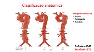 Classificacao anatomica
DeBakey-1965
Stanford-1970
Tempo de evolucao
• Aguda
• Subaguda
• Cronica
 