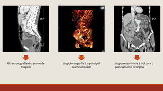 Ultrassonografia é o exame de
triagem
Angiotomografia é o principal
exame utilizado
Angiorressonância é útil para o
planejamento cirúrgico
 