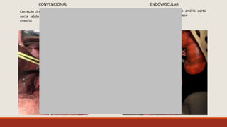 Correção cirúrgica de aneurisma da artéria
aorta abdominal com interposição de
enxerto
CONVENCIONAL
Correção cirúrgica de aneurisma da artéria aorta
abdominal com implante de endoprótese
ENDOVASCULAR
 