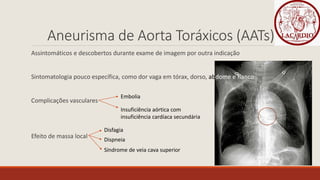 Aneurisma de Aorta Toráxicos (AATs)
Assintomáticos e descobertos durante exame de imagem por outra indicação
Sintomatologia pouco específica, como dor vaga em tórax, dorso, abdome e flanco
Complicações vasculares
Efeito de massa local
Embolia
Insuficiência aórtica com
insuficiência cardíaca secundária
Disfagia
Dispneia
Síndrome de veia cava superior
 