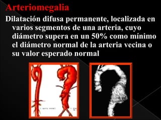 Arteriomegalia
Dilatación difusa permanente, localizada en
varios segmentos de una arteria, cuyo
diámetro supera en un 50% como mínimo
el diámetro normal de la arteria vecina o
su valor esperado normal

 