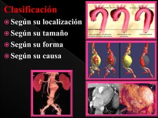 Clasificación
 Según

su localización
 Según su tamaño
 Según su forma
 Según su causa

 