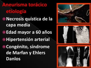 Aneurisma torácico
etiología
 Necrosis quística de la

capa media
 Edad mayor a 60 años
 Hipertensión arterial
 Congénito, síndrome
de Marfan y Ehlers
Danlos

 
