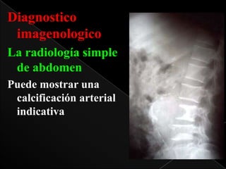 Diagnostico
imagenologico
La radiología simple
de abdomen
Puede mostrar una
calcificación arterial
indicativa

 