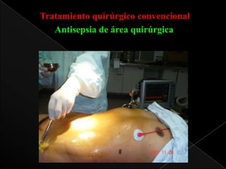Tratamiento quirúrgico convencional
Antisepsia de área quirúrgica

 