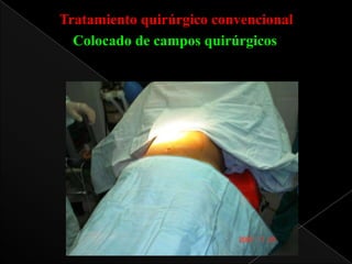 Tratamiento quirúrgico convencional
Colocado de campos quirúrgicos

 