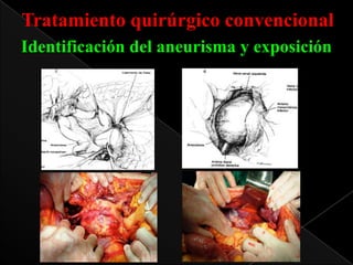 Tratamiento quirúrgico convencional
Identificación del aneurisma y exposición

 