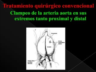 Tratamiento quirúrgico convencional
Clampeo de la arteria aorta en sus
extremos tanto proximal y distal

 
