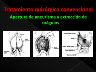 Tratamiento quirúrgico convencional
Apertura de aneurisma y extracción de
coágulos

 