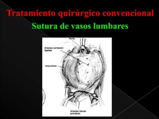 Tratamiento quirúrgico convencional
Sutura de vasos lumbares

 
