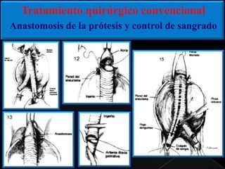 Tratamiento quirúrgico convencional
Anastomosis de la prótesis y control de sangrado

 
