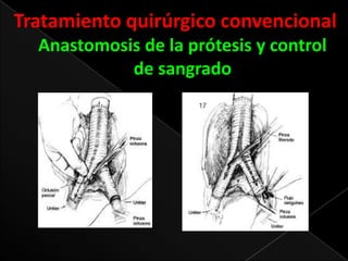 Tratamiento quirúrgico convencional
Anastomosis de la prótesis y control
de sangrado

 