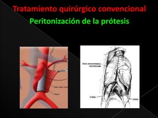 Tratamiento quirúrgico convencional
Peritonización de la prótesis

 