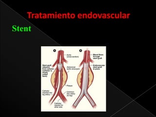 Tratamiento endovascular
Stent

 