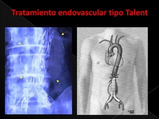 Tratamiento endovascular tipo Talent

 