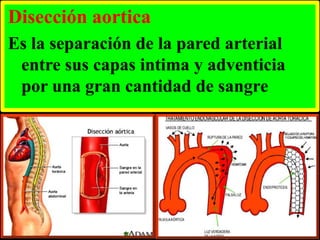 Disección aortica
Es la separación de la pared arterial
entre sus capas intima y adventicia
por una gran cantidad de sangre

 