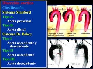 Disección aortica
Clasificación
Sistema Stanford
Tipo A.
Aorta proximal
Tipo B.
Aorta distal

Sistema De Bakey
Tipo I
Aorta ascendente y
descendente
Tipo II
Aorta ascendente
Tipo III
Aorta descendente

 