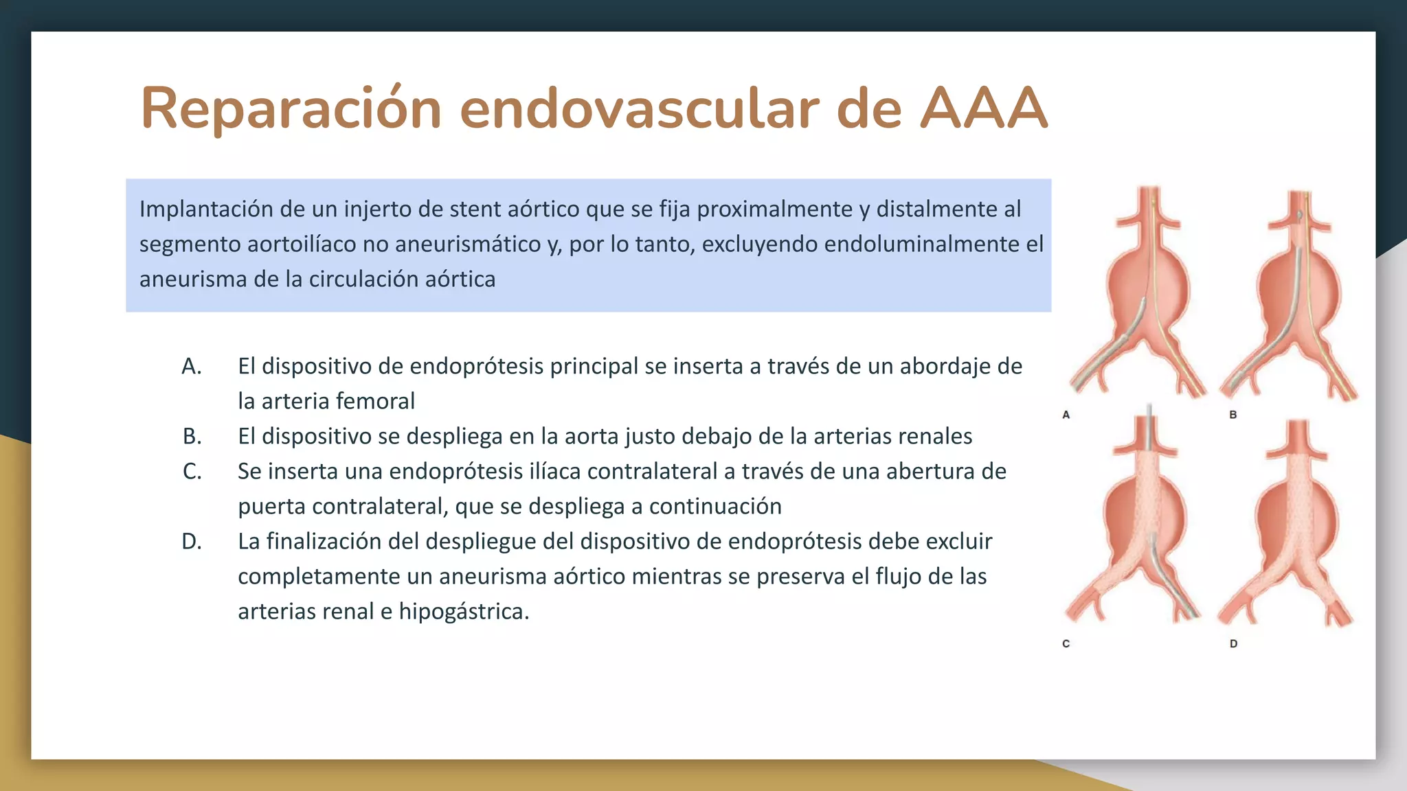 Aneurisma de Aorta Abdominal.pdf