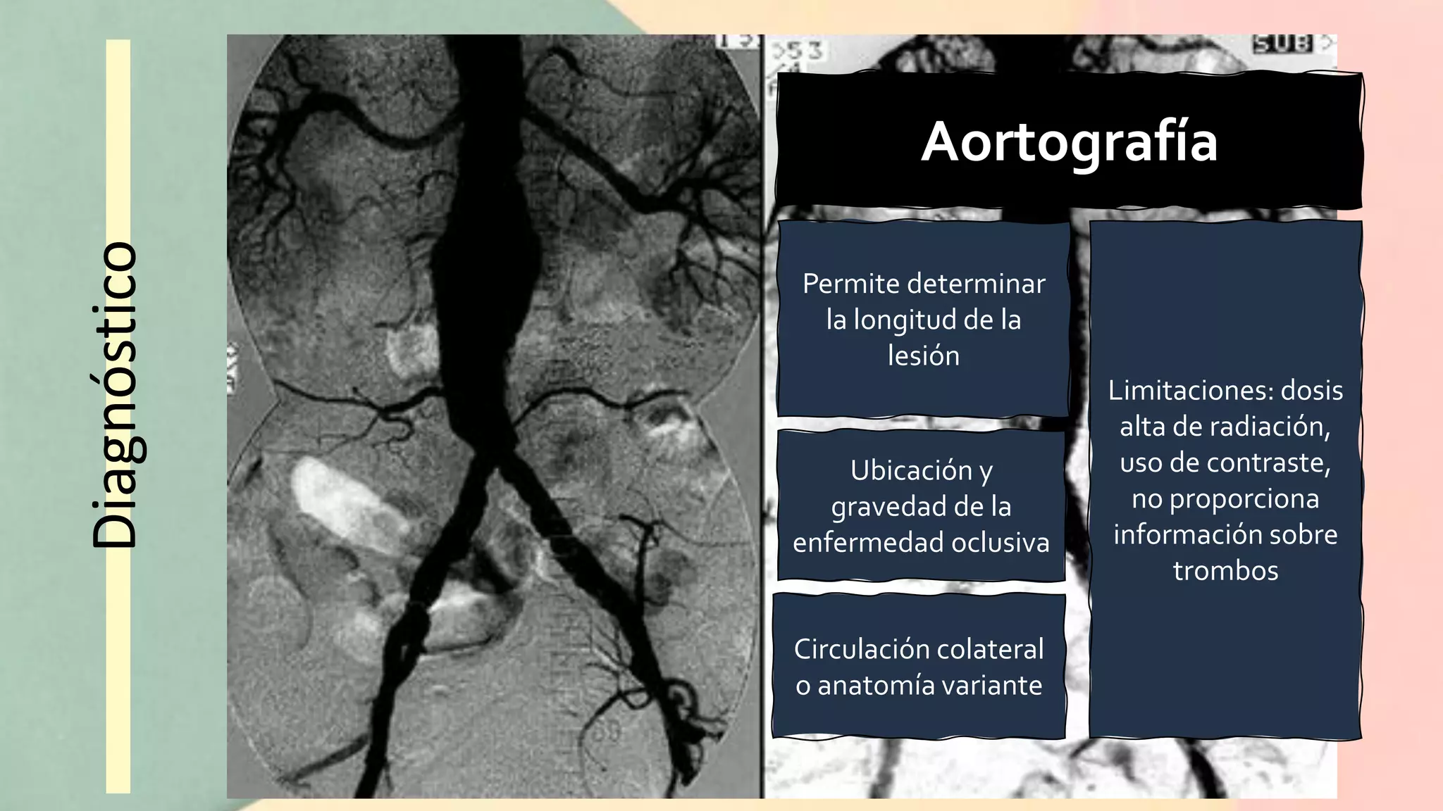 Aneurisma de Aorta Abdominal | PDF