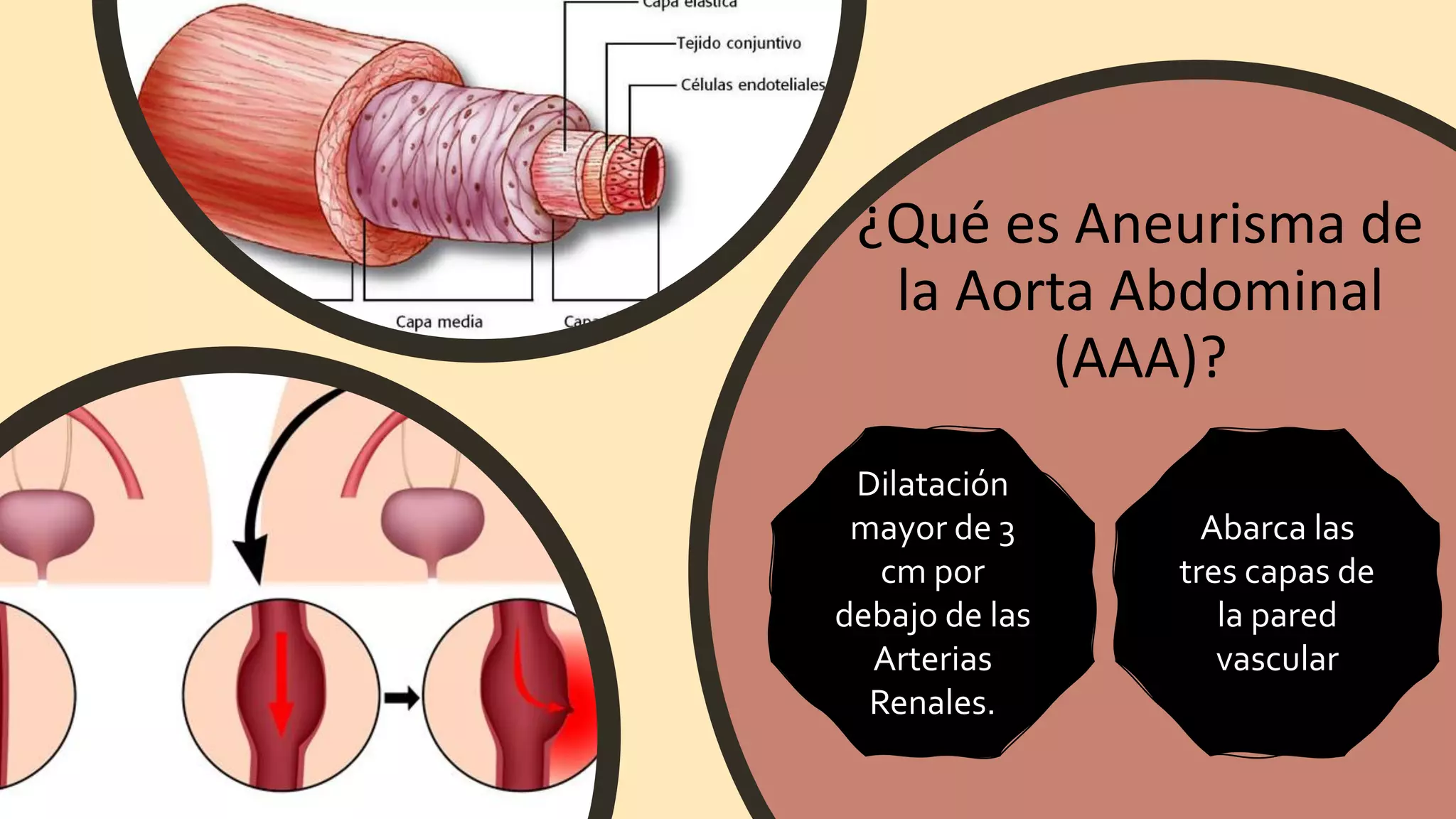 Aneurisma de Aorta Abdominal | PDF