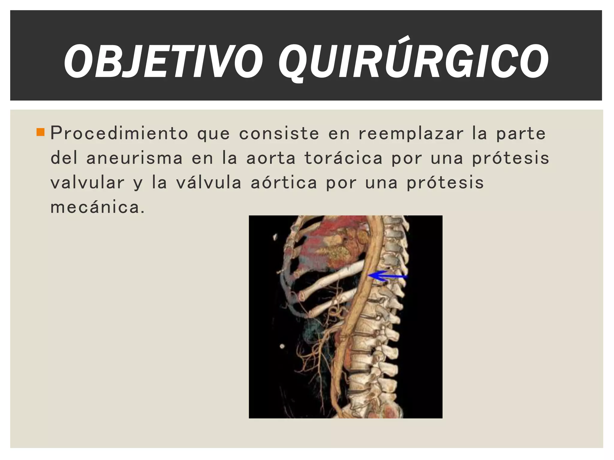 Aneurisma de aorta torácica y reemplazo de válvula aórtica | PPTX