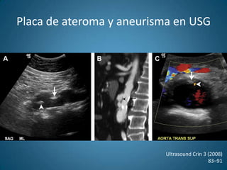 Placa de ateroma y aneurisma en USGUltrasound Crin 3 (2008)83–91