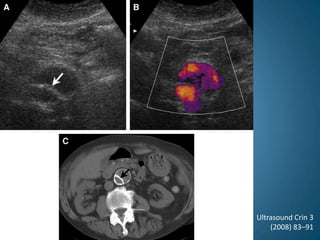 Ultrasound Crin 3(2008) 83–91