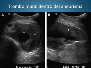 Trombo mural dentro del aneurisma
