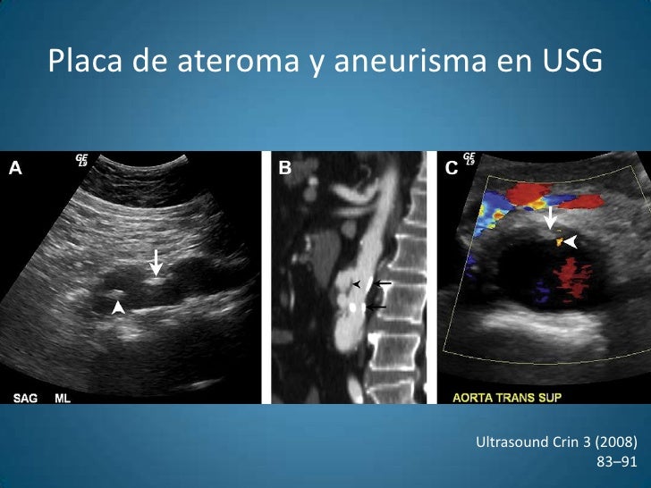 Aneurisma de la aorta abdominal