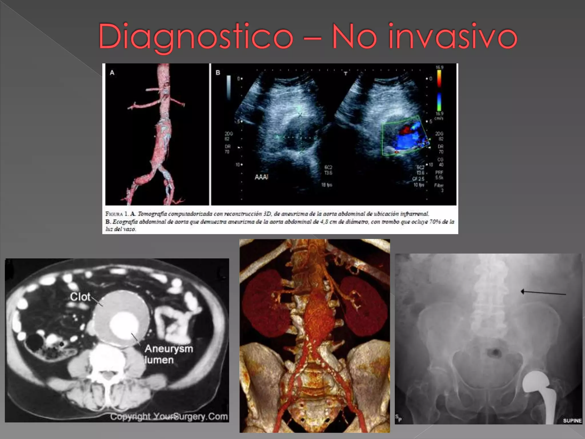 Aneurisma de la aorta abdominal | PPTX