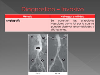 Método Hallazgos y utilidad
Angiografía Se observan las estructuras
vasculares como tal por lo cual se
pueden observar anormalidades y
dilataciones.
 