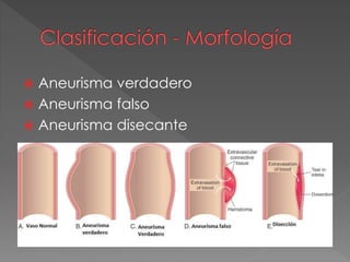  Aneurisma verdadero
 Aneurisma falso
 Aneurisma disecante
 