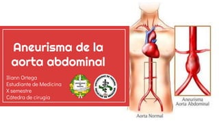 Aneurisma de la
aorta abdominal
Iliann Ortega
Estudiante de Medicina
X semestre
Cátedra de cirugía
 