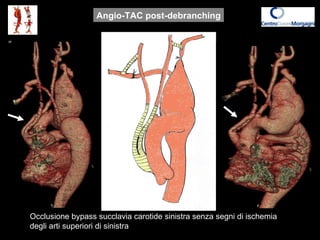 Angio-TAC post-debranching Occlusione bypass succlavia carotide sinistra senza segni di ischemia degli arti superiori di s...