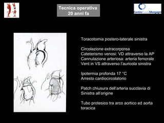 Toracotomia postero-laterale sinistra Circolazione extracorporea Cateterismo venosi: VD attraverso la AP  Cannulazione art...