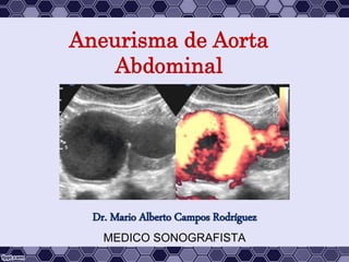 Aneurisma de Aorta
Abdominal
Dr. Mario Alberto Campos Rodríguez
MEDICO SONOGRAFISTA
 