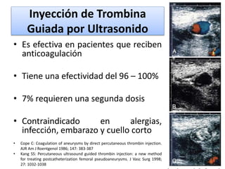Aneurismas arteriales miembros inferiores | PPTX
