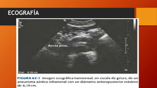Aneurismas de aorta abdominal | PPTX