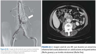 Aneurismas de aorta abdominal | PPTX