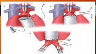 Aneurismas de aorta abdominal | PPTX