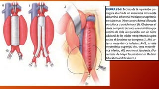 Aneurismas de aorta abdominal | PPTX