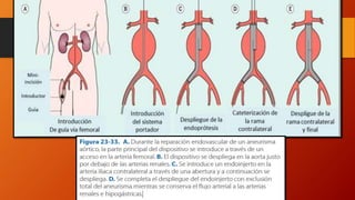 Aneurismas de aorta abdominal | PPTX