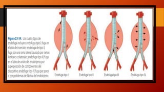 Aneurismas de aorta abdominal | PPTX