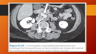 Aneurismas de aorta abdominal | PPTX