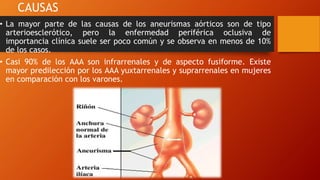 Aneurismas de aorta abdominal | PPTX